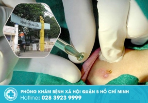 Bảng giá đốt sùi mào gà ở bệnh viện da liễu TPHCM