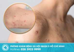 Mụn HIV Cần phân biệt với các mụn viêm nhiễm thông thường